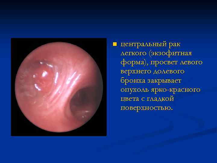 n центральный рак легкого (экзофитная форма), просвет левого верхнего долевого бронха закрывает опухоль ярко-красного