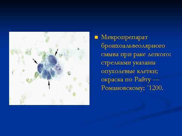 n Микропрепарат бронхоальвеолярного смыва при раке легкого: стрелками указаны опухолевые клетки; окраска по Райту