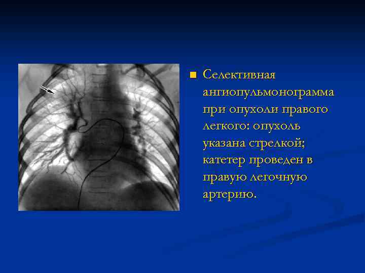 n Селективная ангиопульмонограмма при опухоли правого легкого: опухоль указана стрелкой; катетер проведен в правую