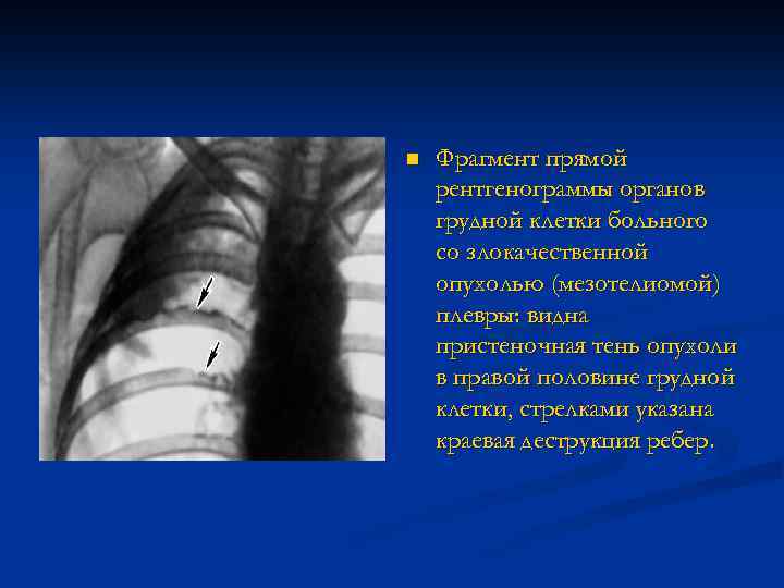 n Фрагмент прямой рентгенограммы органов грудной клетки больного со злокачественной опухолью (мезотелиомой) плевры: видна