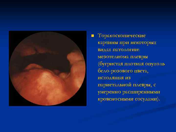 n Торакоскопические картины при некоторых видах патологии: мезотелиома плевры (бугристая плотная опухоль бело-розового цвета,