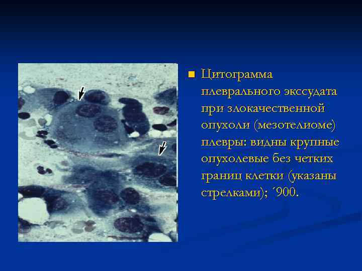 n Цитограмма плеврального экссудата при злокачественной опухоли (мезотелиоме) плевры: видны крупные опухолевые без четких