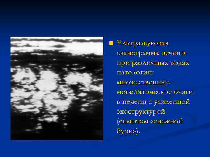 n Ультразвуковая сканограмма печени при различных видах патологии: множественные метастатические очаги в печени с