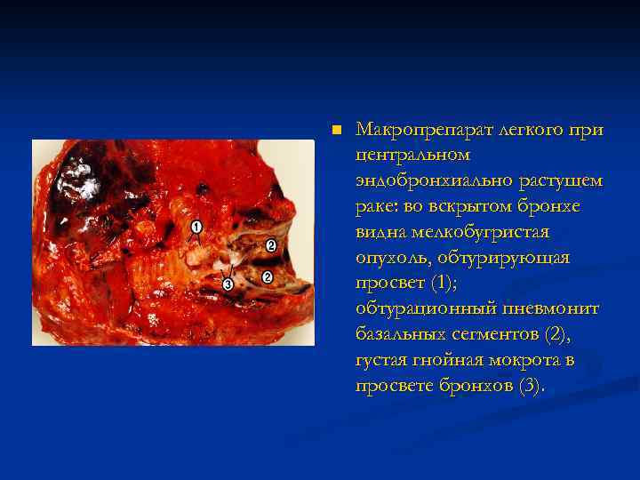 n Макропрепарат легкого при центральном эндобронхиально растущем раке: во вскрытом бронхе видна мелкобугристая опухоль,