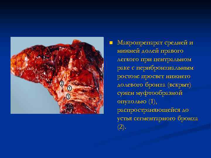 n Макропрепарат средней и нижней долей правого легкого при центральном раке с перибронхиальным ростом:
