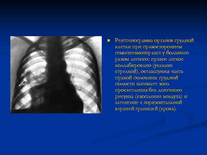 n Рентгенограмма органов грудной клетки правостороннем гемопневмотораксе у больного раком легкого: правое легкое коллабировано