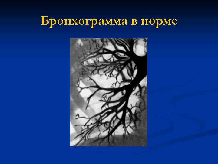 Бронхограмма в норме 