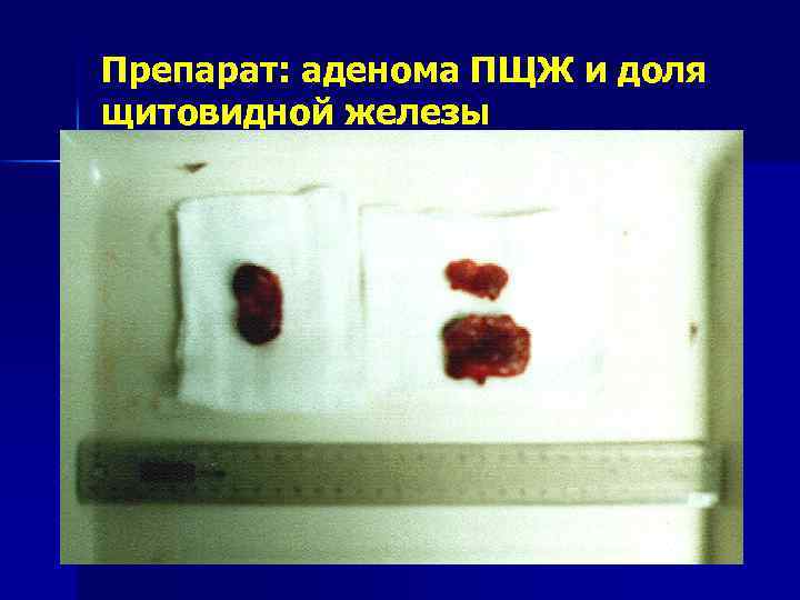 Препарат: аденома ПЩЖ и доля щитовидной железы 