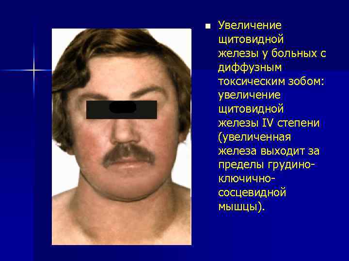 n Увеличение щитовидной железы у больных с диффузным токсическим зобом: увеличение щитовидной железы IV