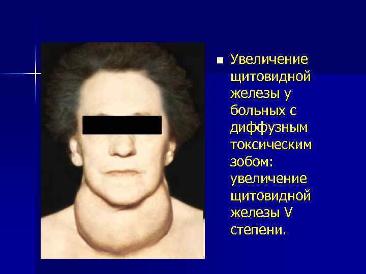 n Увеличение щитовидной железы у больных с диффузным токсическим зобом: увеличение щитовидной железы V