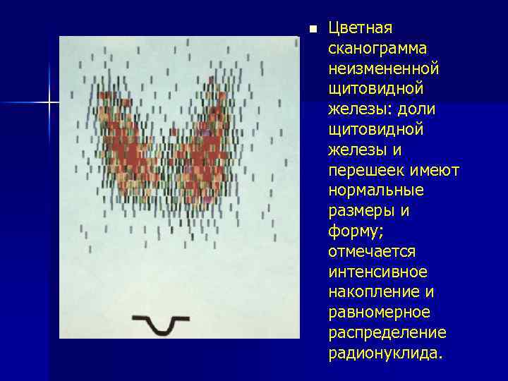 n Цветная сканограмма неизмененной щитовидной железы: доли щитовидной железы и перешеек имеют нормальные размеры