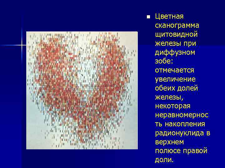 n Цветная сканограмма щитовидной железы при диффузном зобе: отмечается увеличение обеих долей железы, некоторая