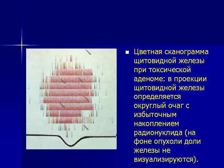 n Цветная сканограмма щитовидной железы при токсической аденоме: в проекции щитовидной железы определяется округлый