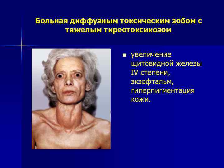 Больная диффузным токсическим зобом с тяжелым тиреотоксикозом n увеличение щитовидной железы IV степени, экзофтальм,