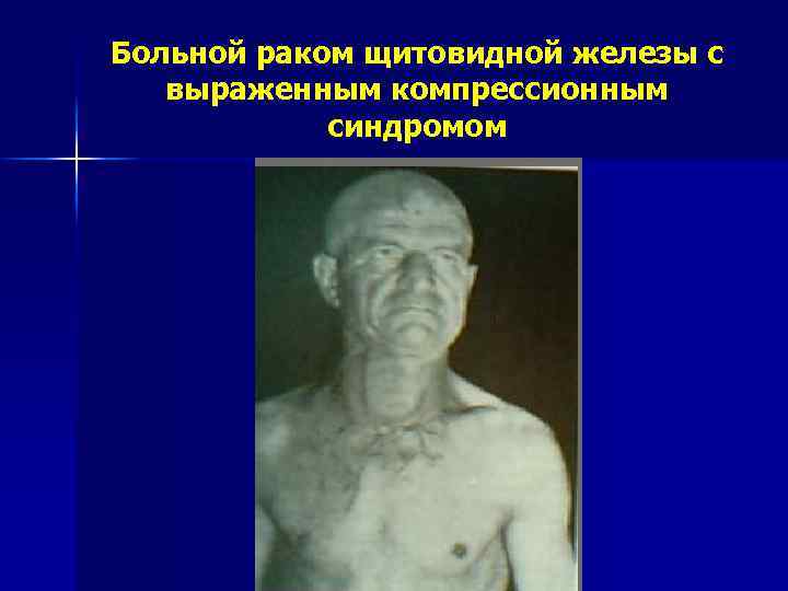 Больной раком щитовидной железы с выраженным компрессионным синдромом 