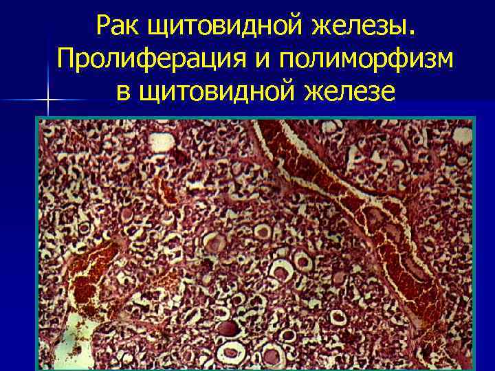 Рак щитовидной железы. Пролиферация и полиморфизм в щитовидной железе 