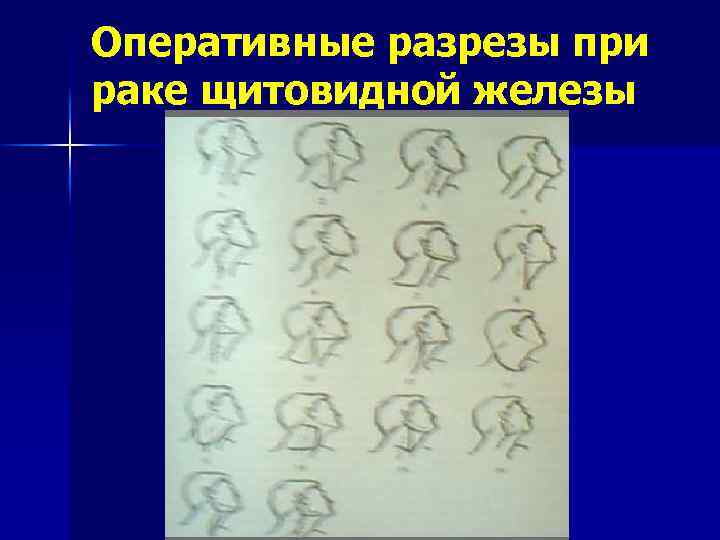 Оперативные разрезы при раке щитовидной железы 