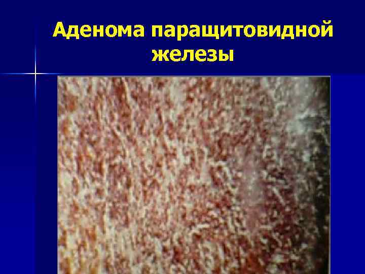 Аденома паращитовидной железы 