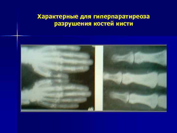 Характерные для гиперпаратиреоза разрушения костей кисти 