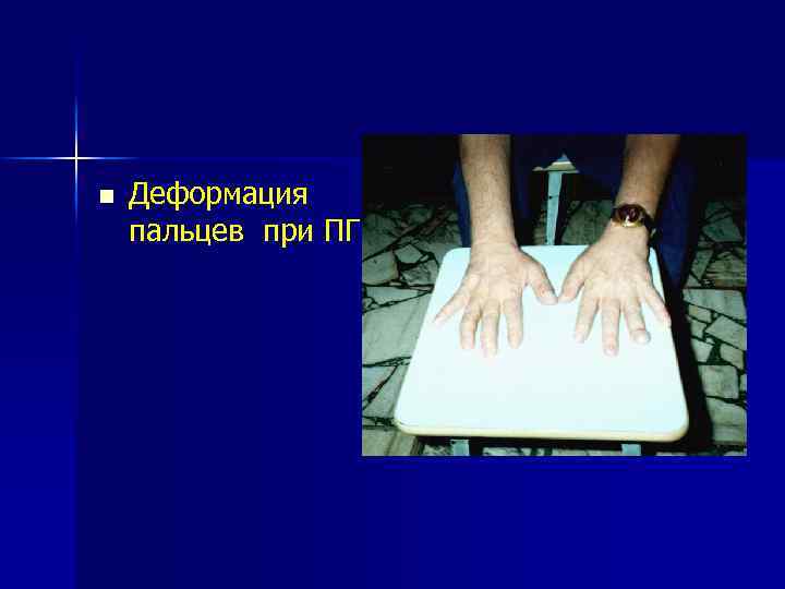 n Деформация пальцев при ПГПТ 