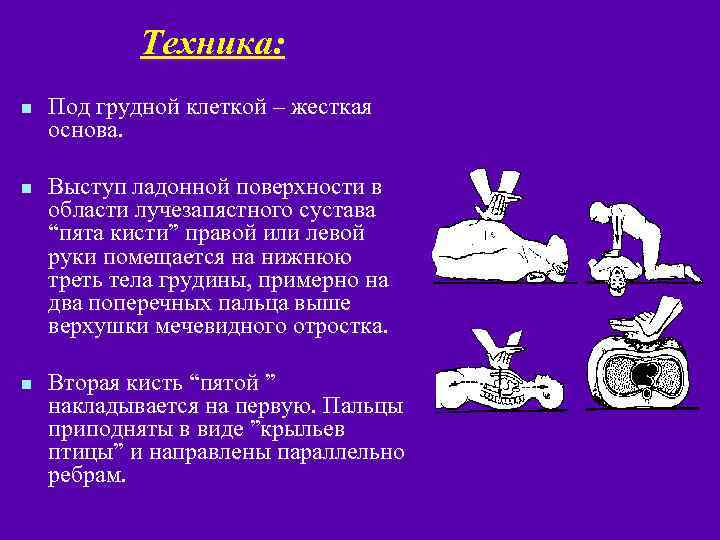 Техника: n n n Под грудной клеткой – жесткая основа. Выступ ладонной поверхности в