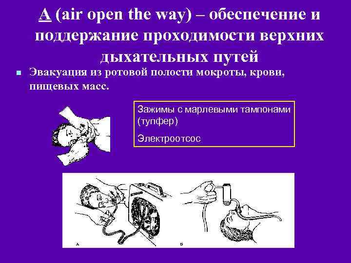 А (air open the way) – обеспечение и поддержание проходимости верхних дыхательных путей n