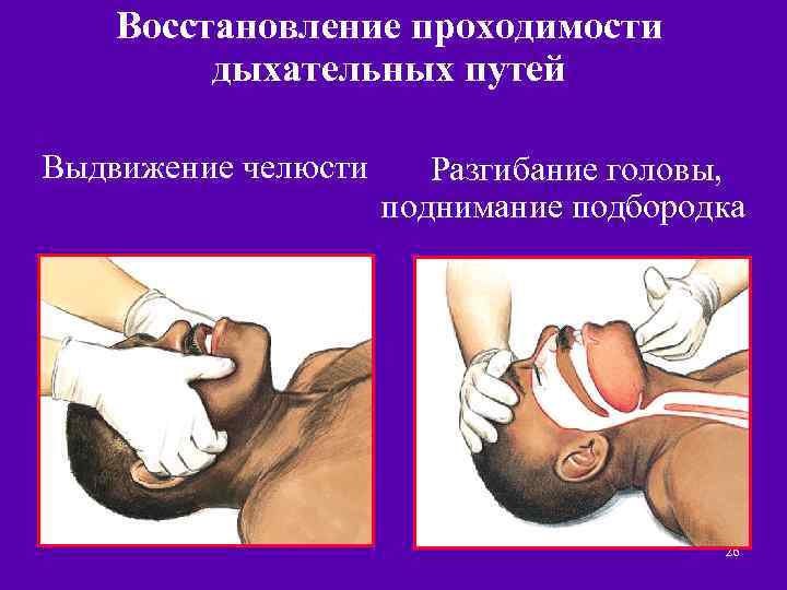 Восстановление проходимости дыхательных путей Выдвижение челюсти Разгибание головы, поднимание подбородка 26 