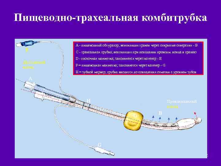 Пищеводно-трахеальная комбитрубка A - пищеводный обтуратор; вентиляция трахеи через открытые отверстия - B E