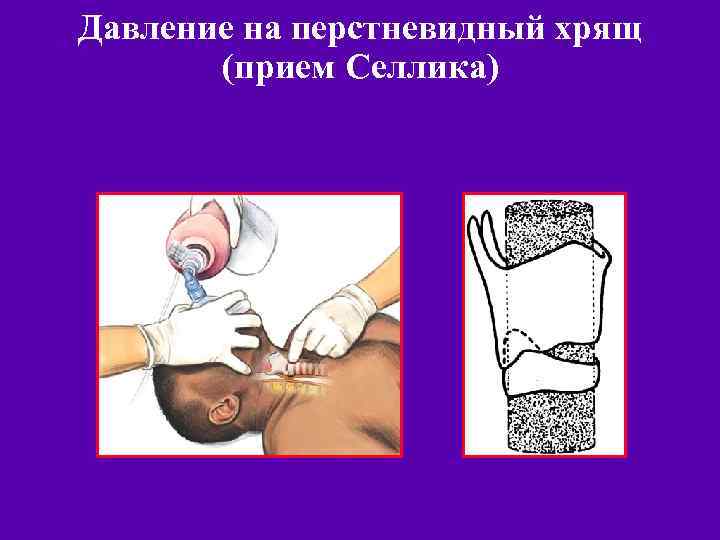 Давление на перстневидный хрящ (прием Селлика) Щитовидный хрящ Перстневидный 