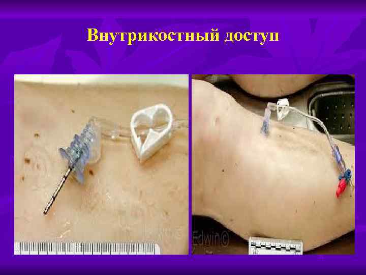 Внутрикостный доступ 