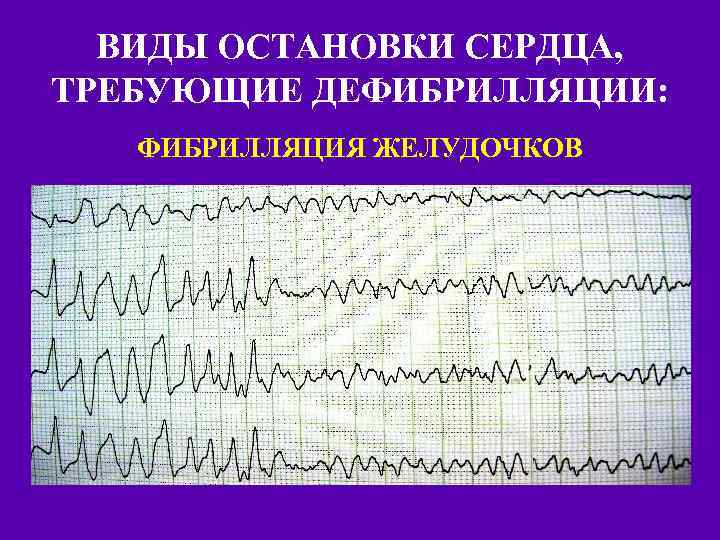 ВИДЫ ОСТАНОВКИ СЕРДЦА, ТРЕБУЮЩИЕ ДЕФИБРИЛЛЯЦИИ: ФИБРИЛЛЯЦИЯ ЖЕЛУДОЧКОВ 