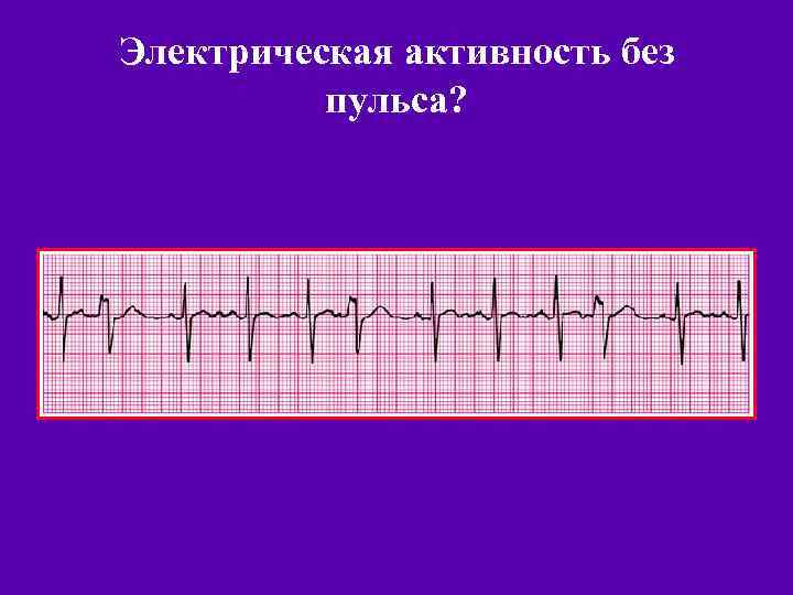 Электрическая активность без пульса