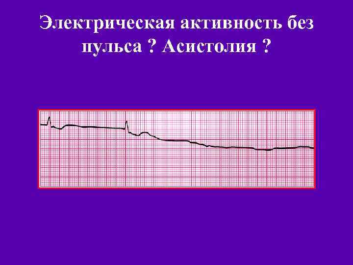 Электрическая активность без пульса ? Асистолия ? 
