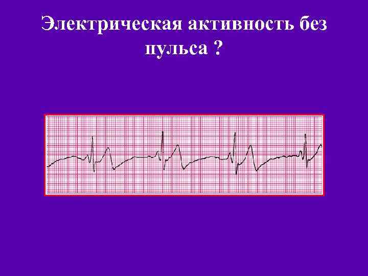 Электрическая активность без пульса ? 