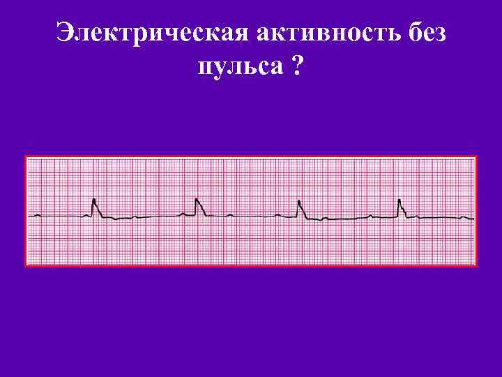 Электрическая активность без пульса ? 