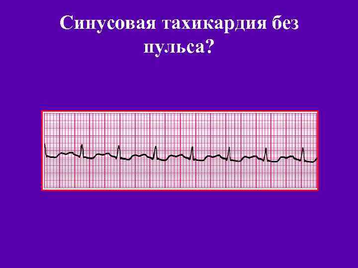 Синусовая тахикардия без пульса? 