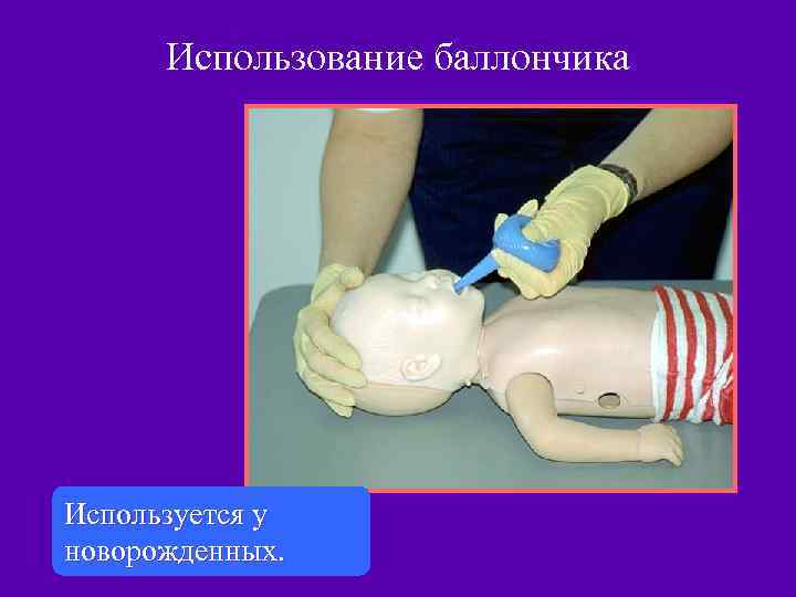 Использование баллончика Используется у новорожденных. 