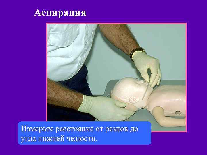 Аспирация Измерьте расстояние от резцов до угла нижней челюсти. 