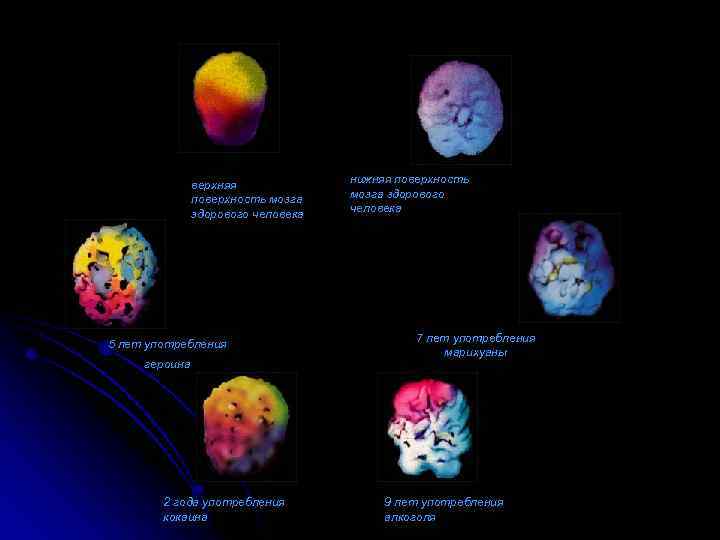 верхняя поверхность мозга здорового человека нижняя поверхность мозга здорового человека верхняя поверхность мозга 5