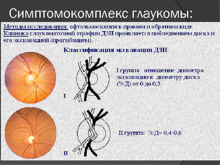 Симптомокомплекс глаукомы: 