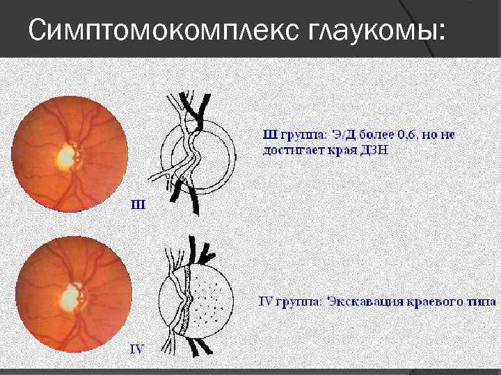 Симптомокомплекс глаукомы: 