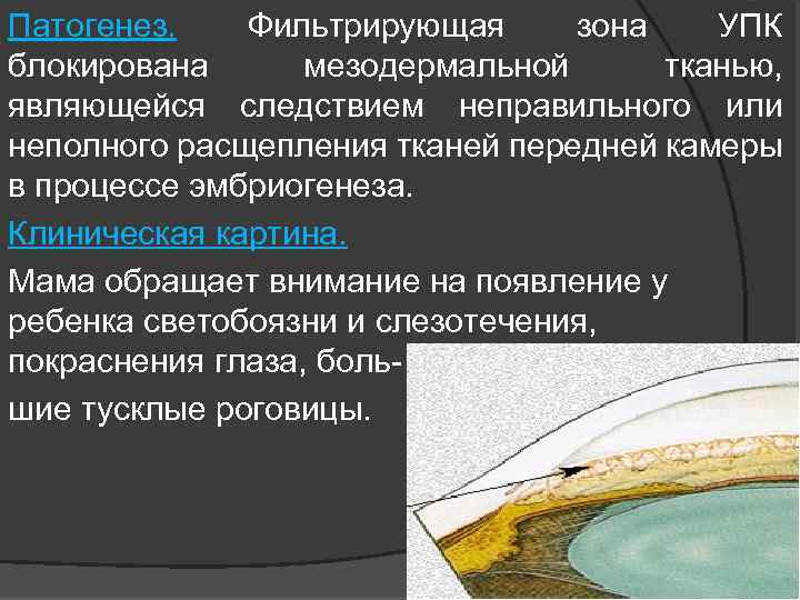 Патогенез. Фильтрирующая зона УПК блокирована мезодермальной тканью, являющейся следствием неправильного или неполного расщепления тканей