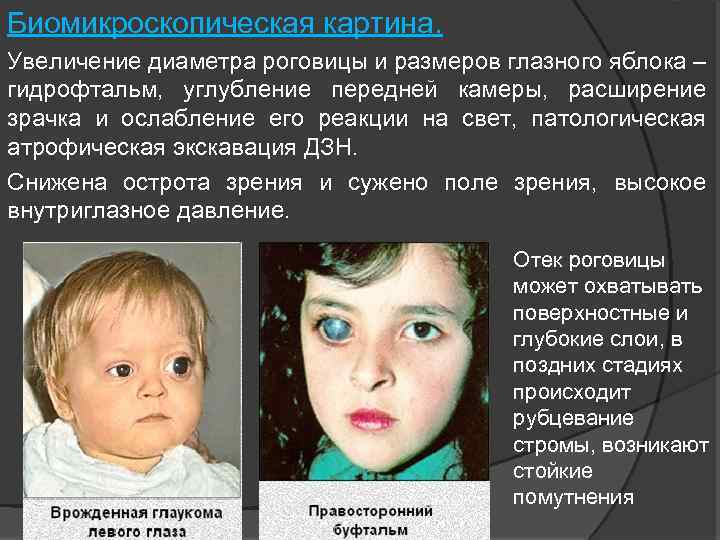 Биомикроскопическая картина. Увеличение диаметра роговицы и размеров глазного яблока – гидрофтальм, углубление передней камеры,