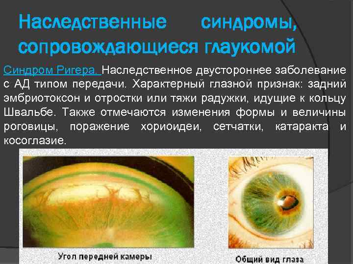 Наследственные синдромы, сопровождающиеся глаукомой Синдром Ригера. Наследственное двустороннее заболевание с АД типом передачи. Характерный