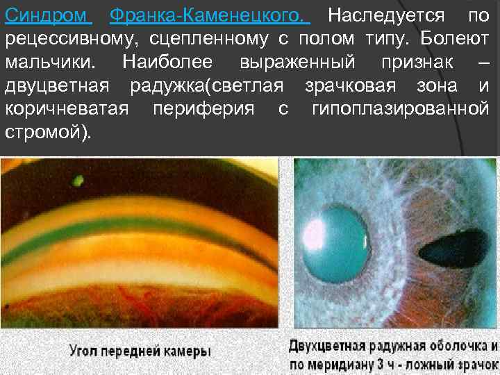 Синдром Франка-Каменецкого. Наследуется по рецессивному, сцепленному с полом типу. Болеют мальчики. Наиболее выраженный признак