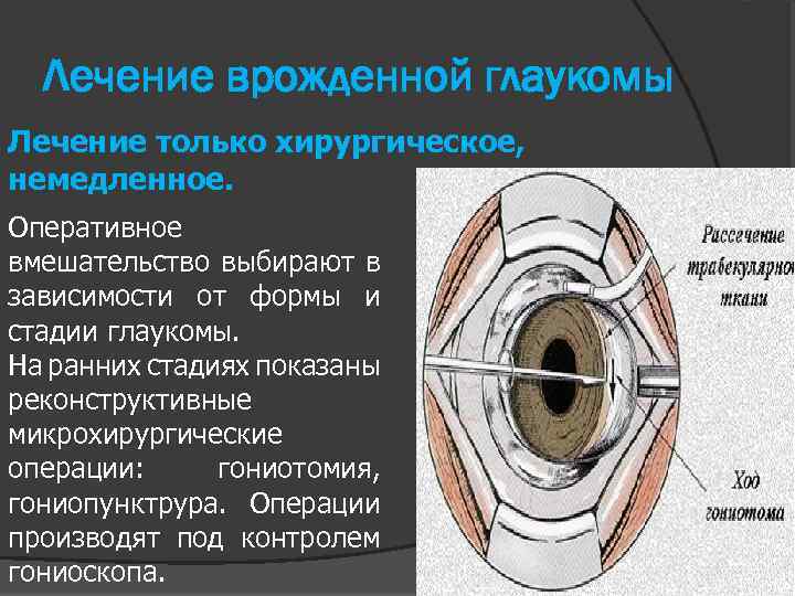 Лечение врожденной глаукомы Лечение только хирургическое, немедленное. Оперативное вмешательство выбирают в зависимости от формы
