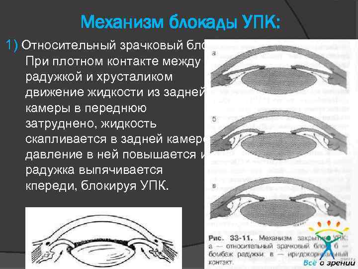 Механизм блокады УПК: 1) Относительный зрачковый блок. При плотном контакте между радужкой и хрусталиком