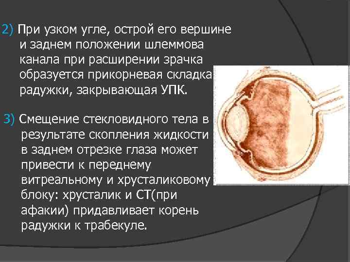 2) При узком угле, острой его вершине и заднем положении шлеммова канала при расширении