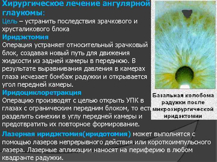 Хирургическое лечение ангулярной глаукомы: Цель – устранить последствия зрачкового и хрусталикового блока Иридэктомия Операция