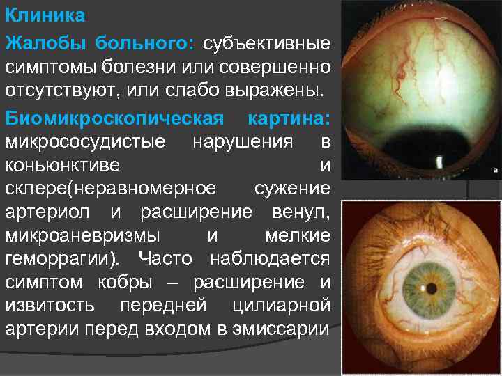 Клиника Жалобы больного: субъективные симптомы болезни или совершенно отсутствуют, или слабо выражены. Биомикроскопическая картина: